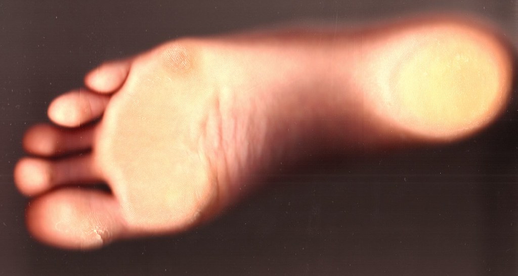 Blessures fréquentes en course à pied : comment les éviter et les soigner